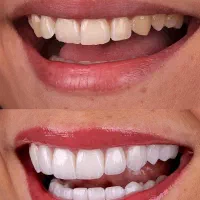 دندان مصنوعی تحویل( ۵ساعته)،کامپوزیت دندان ، روکش|خدمات آرایشگری و زیبایی|تهران, میدان ولیعصر|دیوار