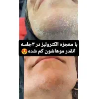 الکترولیز موهای زائد سفید و مشکی صورت