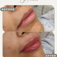 فیلر ، بوتاکس، نخ لیفت و کلیه کارهای زیبایی