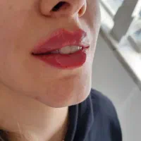 بوتاکس چشم گربه ای|خدمات آرایشگری و زیبایی|تهران, سازمان برنامه شمالی|دیوار
