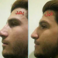 60%تخفیف لیفت صورت.وانجام لیفت بایشترین تعدادنخ|خدمات آرایشگری و زیبایی|مشهد, نیروی هوایی|دیوار