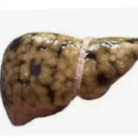 کبد چرب،پاکسازی،اصلاح مزاج(مشاوره تلفنی)