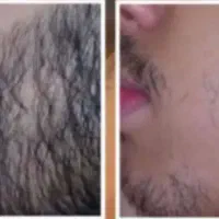 توام از ریزش ریش‌هات رنج میبری