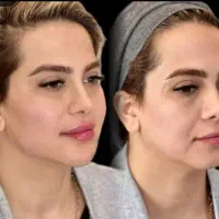 تزریق ژل ،کلاژن،بوتاکس،مزو،پلکسر