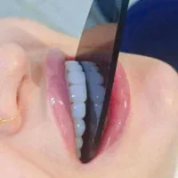 کامپوزیت دندان|خدمات آرایشگری و زیبایی|اردبیل, |دیوار