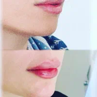 جشنواره ویژه تخفیفی تزریق ژل و بوتاکس و لیزر|خدمات آرایشگری و زیبایی|تهران, نیروی هوایی (پیروزی)|دیوار