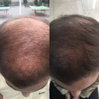 توقف ریزش مو و سلامت دوبارع