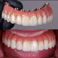 ایمپلنت اقساطی بدون پیش پرداخت.ارتودنسی.دندانپزشکی