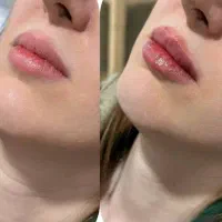 جشنواره ژل لب بوتاکس 700|خدمات آرایشگری و زیبایی|شیراز, زرهی|دیوار