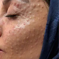جشنواره تخفیفات ویژه مزوتراپی پوست و مو درکلینیک|خدمات آرایشگری و زیبایی|اصفهان, درب کوشک|دیوار