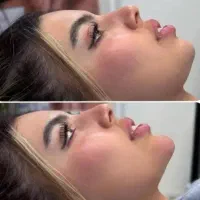 جذب پرستار و تکنسین تزریق