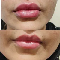 لیزرموهای زائد،ژل،بوتاکس،هایفو،فیشال وپاکسازی پوست|خدمات آرایشگری و زیبایی|کرج, فاز ۴ مهرشهر|دیوار
