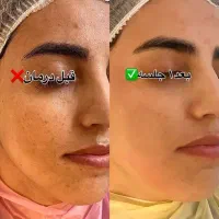 پاکسازی درمانی و تخصصی پوست برا خانم ها و آقایان|خدمات آرایشگری و زیبایی|کاشان, زیدی|دیوار