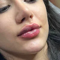 بوتاکس،فیلر توسط پزشک پوست و زیبایی(تخفیف استثنایی|خدمات آرایشگری و زیبایی|تهران, دروس|دیوار