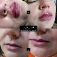 لیفت وجوانسازی با نخ های کاگ و تزریق فیلر ومزوها|خدمات آرایشگری و زیبایی|شیراز, میانرود|دیوار