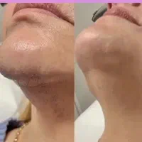 لیزر موهای زائد بانوان الکساندرایت نابلکس شاتی|خدمات آرایشگری و زیبایی|قزوین, |دیوار