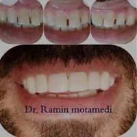 ایمپلنت/کامپوزیت/دندانپزشکی/اقساط|خدمات آرایشگری و زیبایی|شیرگاه, |دیوار