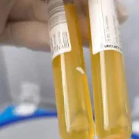 جشنواره پی ار پی prpواگزوزوم تراپی‌،تکنیک پوست مار