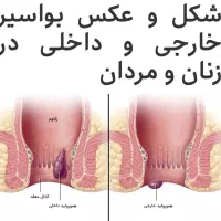 یبوست ، شقاق ،بواسیر