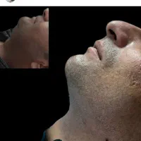 ژل .بوتاکس .هایفو.ساکشن غبغب وساکشن شکم وپهلو|خدمات آرایشگری و زیبایی|اصفهان, رکن الدوله غربی|دیوار