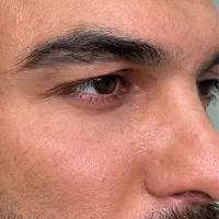 جراحی پلک با متد چشم گربه ایی با بخیه لیزری|خدمات آرایشگری و زیبایی|تهران, قیطریه|دیوار