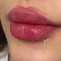 ژل و بوتاکس|خدمات آرایشگری و زیبایی|کرمانشاه, |دیوار