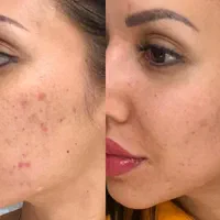 پاکسازی و روشنسازی و جوانسازی پوست|خدمات آرایشگری و زیبایی|مشهد, شهید فرامرز عباسی|دیوار