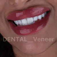 کامپوزیت دندان   تکنیک لیرینگ    لمینت ( اقساط)|خدمات آرایشگری و زیبایی|تهران, قیطریه|دیوار