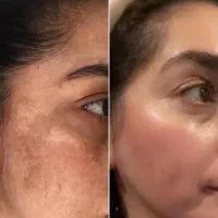 رفع لک و جوانسازی تضمینی