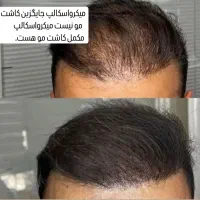 میکرو اسکالپ مکمل کاشت مو|خدمات آرایشگری و زیبایی|یاسوج, |دیوار
