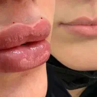 تزریق ژل وبوتاکس فول فیس. صورت تزریق فیلربادی