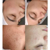 فشیال وپاکسازی صورت|خدمات آرایشگری و زیبایی|نیشابور, شهرک اندیشه|دیوار