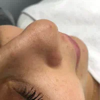 رفع چین و چروک،میکرونیدلینگ،جوانسازی صورت،فیشالVIP|خدمات آرایشگری و زیبایی|قدس, شهر‌قدس|دیوار