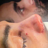 جراحی عمل بینی