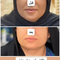 هایفوتراپی14بعدی برای نخستین بار در غرب کشور|خدمات آرایشگری و زیبایی|خرم‌آباد, |دیوار