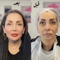 بوتاکس پیشانی /جوانسازی بیکینی بانوان /ژل صورت ۷۵۰