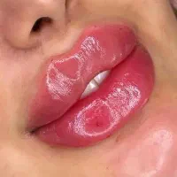 فیلر ژل بوتاکس تخفیف بهاری ظرفیت محدود