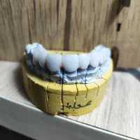 لابراتوار دندانسازی (روکش ثابت)