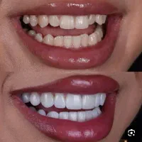 جشنواره کامپوزیت دندان فقط واحدی 700|خدمات آرایشگری و زیبایی|فولادشهر, B4|دیوار