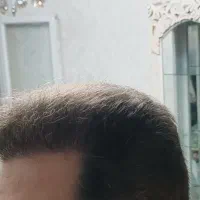 کاشت مو باضمانتنامه کتبی مادام العمر|خدمات آرایشگری و زیبایی|تبریز, |دیوار