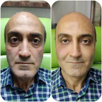 مدل برای درمان افتادگی های صورت و ژل لب و بوتاکس|خدمات آرایشگری و زیبایی|تهران, میرداماد|دیوار