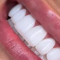 خدمات دندانپزشکی و زیبایی چکی|خدمات آرایشگری و زیبایی|ساری, |دیوار