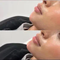 تخفیفات بلک فرایدی ژل و بوتاکس درمطب|خدمات آرایشگری و زیبایی|خرم‌آباد, |دیوار