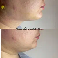 جراح پلک بلفارو ژل چربی صورت ساکشن شکم بوتاکس لیزر