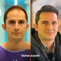 کاشت مو و ابرو اقساطی حتی با سفته|خدمات آرایشگری و زیبایی|مشهد, وکیل‌آباد|دیوار