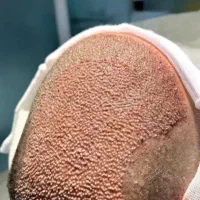 کاشت مو با بالا ترین تراکم و نازلترین قیمت|خدمات آرایشگری و زیبایی|تبریز, |دیوار