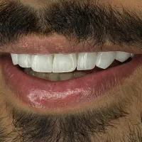آموزش کامپوزیت ونیر
