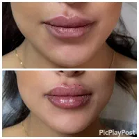 تزریق ژل و بوتاکس و جوانساز و مزوژل فقط هزینه مواد