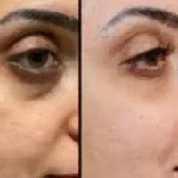 تخفیف یک میلیون تومانی فیلر زیر چشم