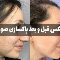 آف پاکسازی پوست صورت|خدمات آرایشگری و زیبایی|مسجد سلیمان, |دیوار